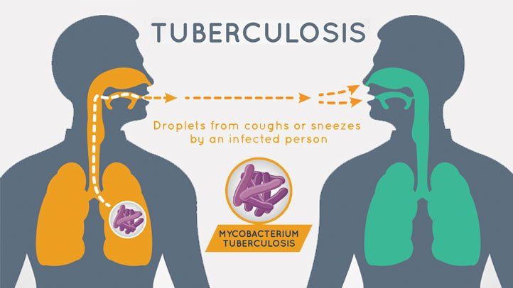 Tuberculosis-risk-factors-causes-and-prevention-722x406.jpg