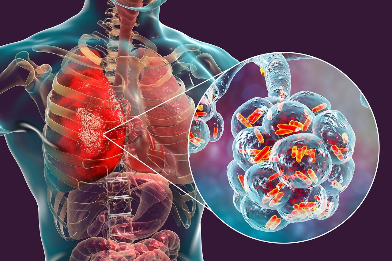 1800ss_getty_rf_legionnaires_disease.jpg